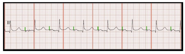 <p>The identification of the above ECG is:</p><p>a. Atrial pacing </p><p>b. Ventricular pacing </p><p>c. Failure to capture</p><p>d. Failure to sense</p><p></p>