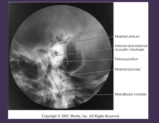 <p>mastoid antrum</p><p>int+ext acoustic eatuses</p><p>petrou portion</p><p>mastoid process</p><p>mandibular condyle</p>