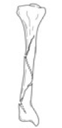 <p>Spiral/Torsion Fracture</p>