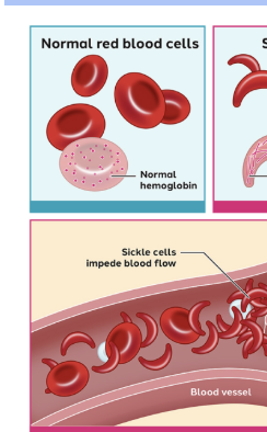 <p><span style="background-color: transparent;">Sickle cell Disease</span></p>