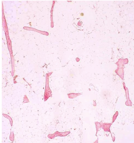 <p>Biopsie osseuse </p><p>1) diagnostic</p><p>2) histo</p>