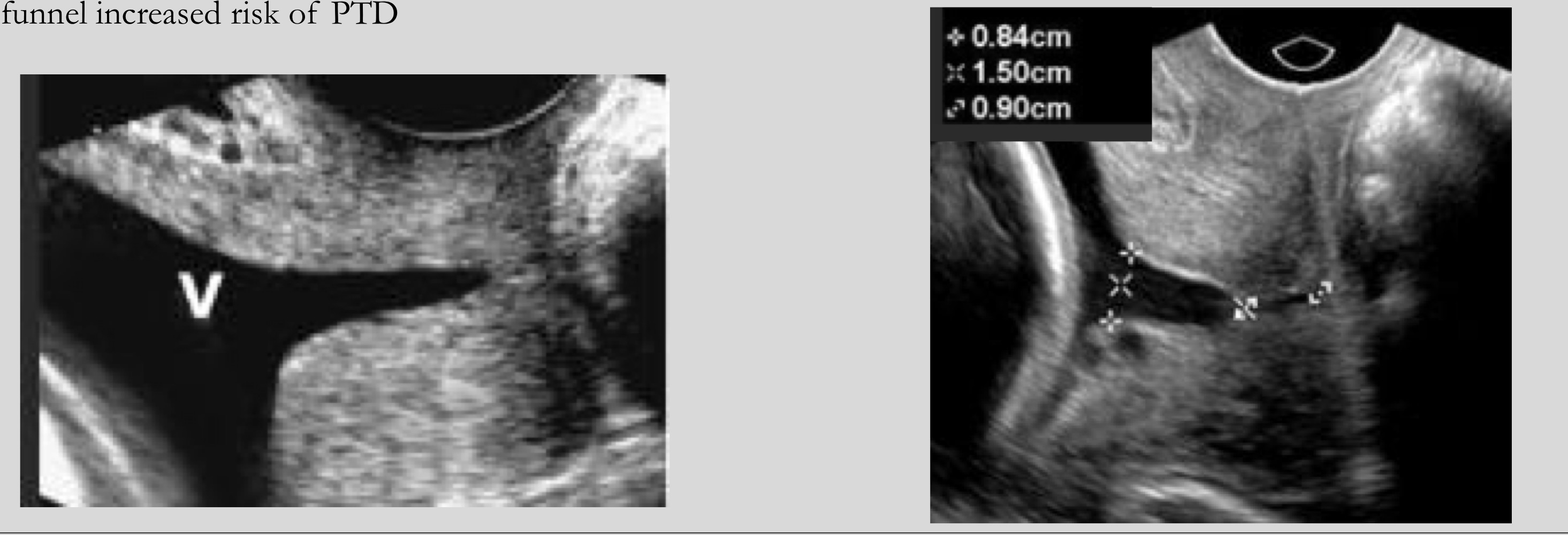<p>U-shaped or V-shaped</p>