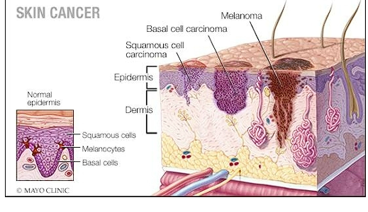 <p>Neoplastic lesions</p>
