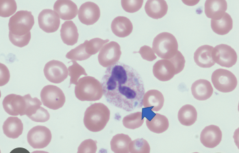 <ul><li><p>Light-blue stain in the cytoplasm of neutrophils</p></li><li><p>Condition: bacterial infections</p></li></ul><p></p>