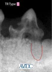 <p>what type of tooth resorption is this?</p>