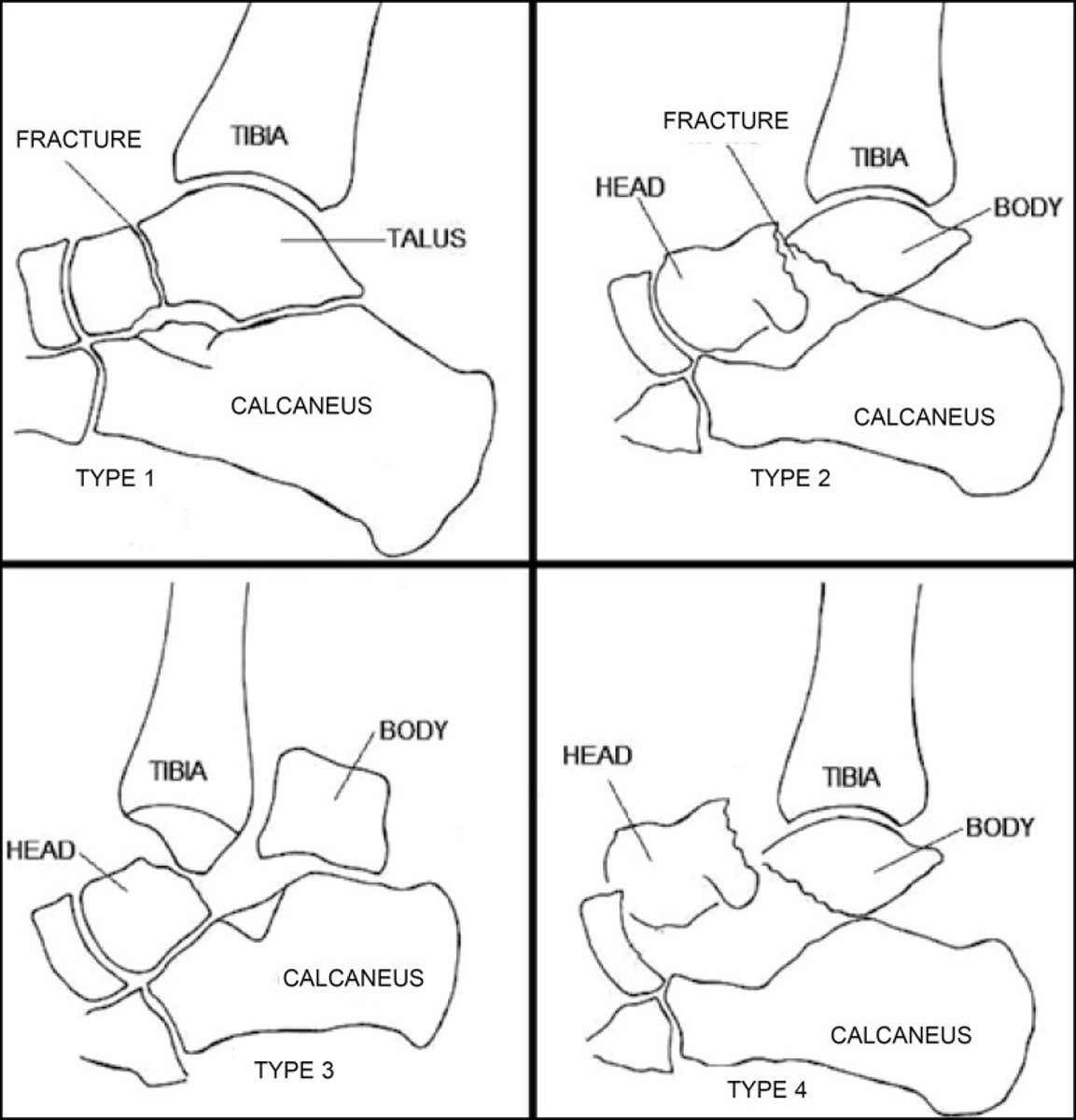 <p>HAWKINS - Talar neck fx</p><p>Type 1 - vertical fracture of talar neck that is nondisplaced</p><p>Type 2 - vertical fracture of talar neck with STJ dislocation/subluxation</p><p>Type 3 - vertical fracture of talar neck with STJ and ankle dislocation/subluxation</p><p>Type 4 - vertical fracture of talar neck with STJ, ankle, and T-N dislocation/subluxation</p>