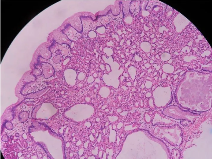 <p>Polype de l’estomac</p><p>1) diagnostic</p><p>2) contexte, localisation</p><p>3) Histologie</p>