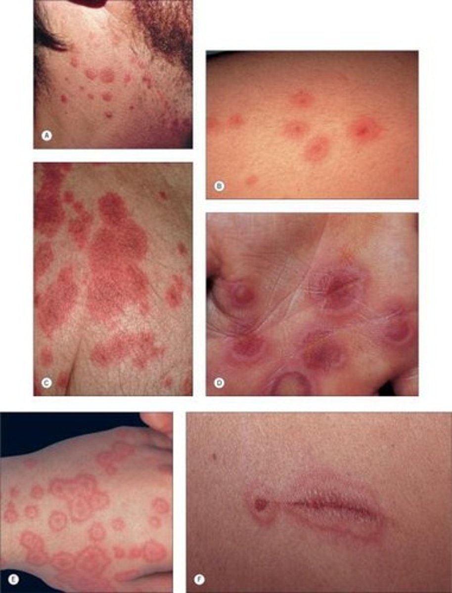 <p>Target-like shape, raised, blanching, and lack of itchiness help characterize this rash</p>