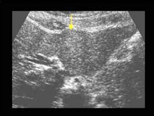 <p>PT is on BCPs, and presents with RUQ pain and palpable mass what is the diagnosis</p>