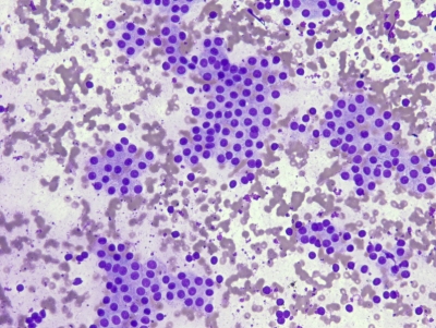 <p>Nodule thyroïdien.</p><p>1) Diagnostic cytologique selon bethesda</p><p>2) terme diagnostic</p><p>3) entités histologiques possibles </p><p>4) Cytologie</p><p>5) DD carcinome folliculaire</p>