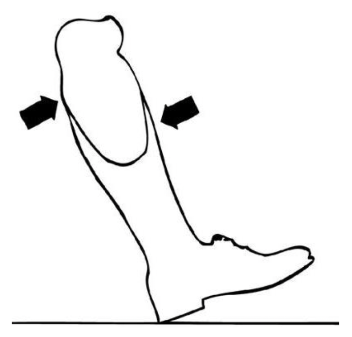<p>anterior-distal, posterior proximal </p>