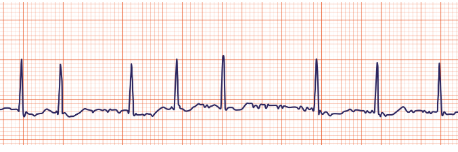 <p>what does this EKG show? </p>