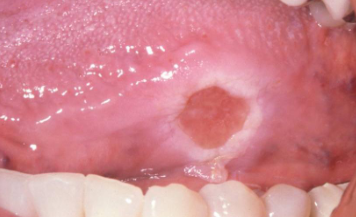 <p>deep, chronic ulceration due to repetitive trauma causing damage to muscle; very slow resolution (months to years); more common in adults; usually found on the tongue over buccal mucosa and lips </p>