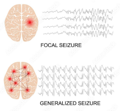<p>EEG for Seizures</p>