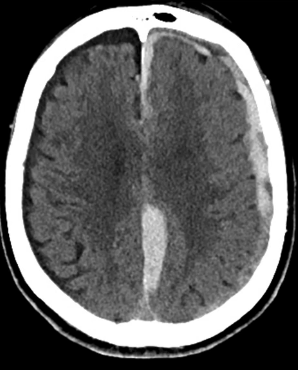 <p>accumulation of blood between dura and arachnoid mater traveling to the dural sinuses </p>