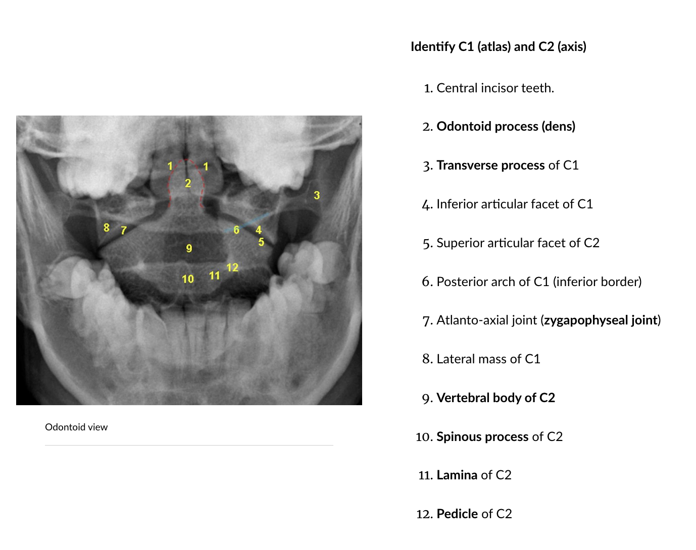 <p>Odontoid open mouth view </p>