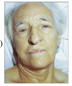 <p>- Commonest cause of Vitamin B12 Deficiency</p><p>- Auto-immune disease (family history; blood group A)</p><p>- auto-antibodies to parietal cells or intrinsic factor interfere with formation IF-B12 complex and B12 absorption</p><p>- Females > Males; greying hair</p><p>- Anaemia with "lemon yellow" tint</p><p>- Macrocytic anaemia (MCV > 100 >110 fL)</p><p>- Low Vitamin b12</p><p>- Rx: intra-muscular vitamin B12</p>