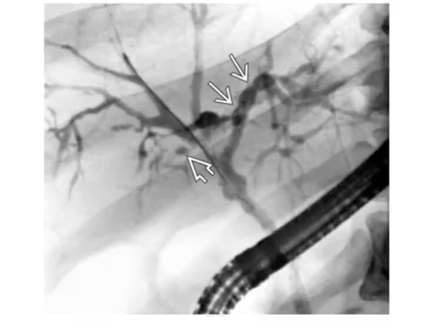 <p>facet z wzjg, podwyższoną fosfatazą zasadową, żółtaczką, co widać w radiologii</p>