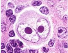 <p>What is this cellular inclusion called? What pathogen causes it?</p>