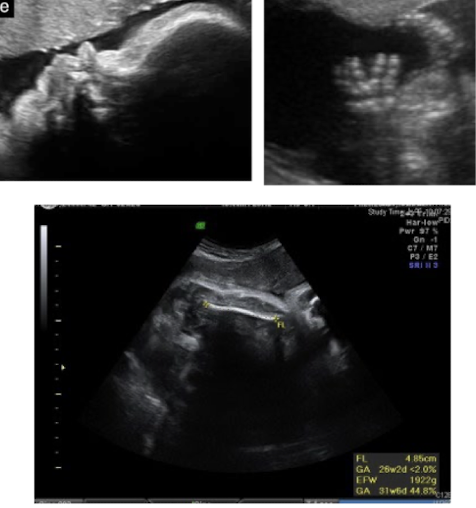 <ul><li><p>rhizomelia</p></li><li><p>microcephaly</p></li><li><p>trident hands</p></li><li><p>depressed nasal bridge</p></li><li><p>frontal bossing</p></li><li><p>mild ventriculomegaly (sometimes)</p></li><li><p><span style="color: red;">long bone shortening after 22 weeks </span>(best diagnostic clue)</p></li></ul><p></p>