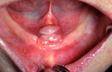 <p>tumor-like hyperplasia of fibrous tissue that develops with the flange of an ill-fitting denture; single or multiple folds along the alveolar ridge </p>