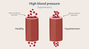 <p>Hypertension (HTN) is also known as?</p>