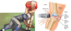 <p>A serious knee injury where three structures are damaged at the same time: </p><p>the ACL, MCL, and medial meniscus.</p>