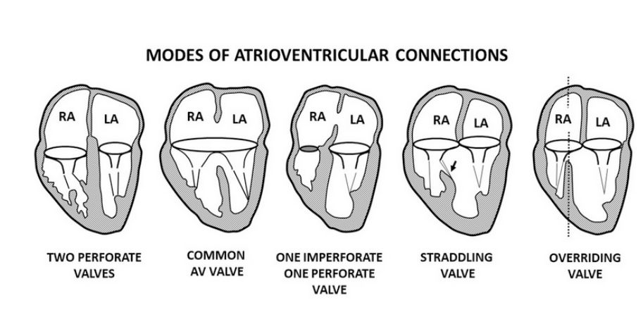 <p>MODES OF CONNECTION INCLUDE TWO PERFORATE VALVES, COMMON AV VALVE, ONE IMPERFORATE AND ONE PERFORATE VALVE AND AV VALVE STRADDLING AND OVERRIDING</p>
