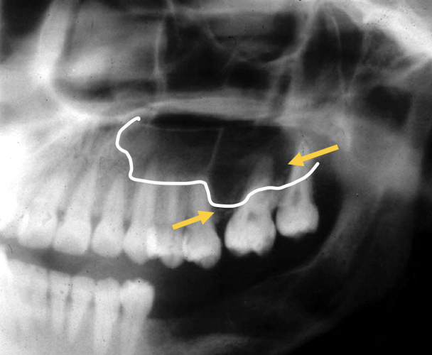 <p>What is indicated clinically in the radiograph</p>
