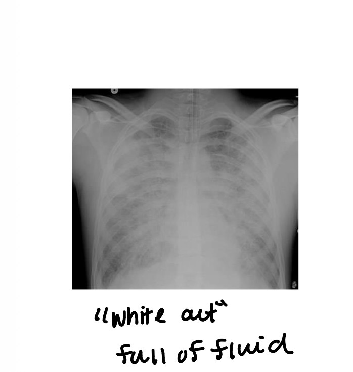 <p>Interstitial/alveolar infiltrations</p><p>• Diffuse, bilateral, symmetrical</p><p>• “Ground Glass” or “White-out”</p>