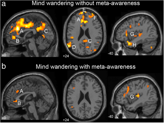 <p><span style="background-color: transparent;">Christoff et al. (2007) ESM (experience sampling) during fMRI</span></p><ul><li><p><span style="background-color: transparent;">Comparison of mind wandering with and without awareness</span></p></li><li><p><span style="background-color: transparent;">Mind wandering without awareness : errors on SART, default mode network is much more active (DMN is what the brain does when not engaged in a task etc)</span></p></li><li><p><span style="background-color: transparent;">Mind wandering with awareness (aware of your own awareness): not so much default mode network stuff going on. reported during probes. Suggests more in control of your own thinking&nbsp;</span></p></li></ul><p></p>