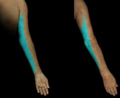 <p>D: Medial side of forearm to base of little finger</p><p>M:</p>