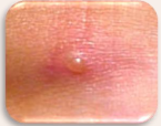 <p>What is the type of lesion and how is it defined?</p>