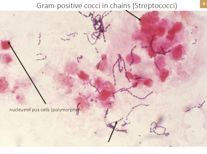 <p>Gram positive cocci in chains (streptococci)</p>