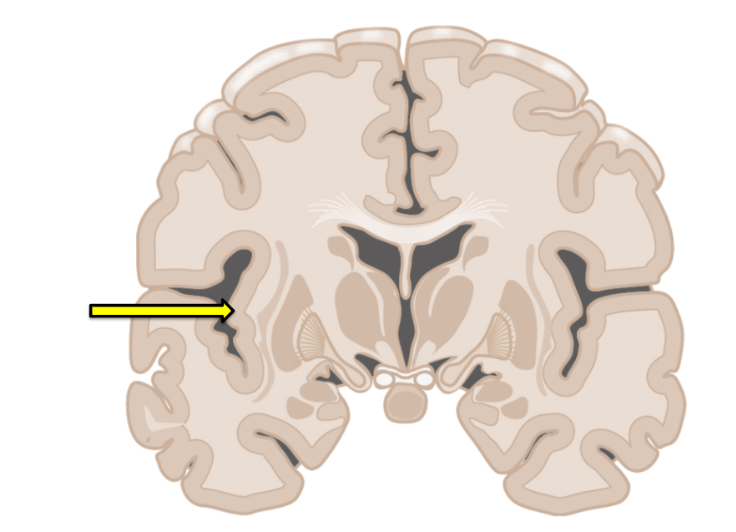 <p>It is the claustrum and little is known about its function</p><p>It is the temporal lobe, which plays a role in processing auditory information</p><p>It is the insula, which plays a role in interoception (internal sense) and social emotion</p><p>It is the parietal lobe, which plays a role in integrating sensory information</p><p>It is part of the basal ganglia, which plays a role in the coordination of movement</p>