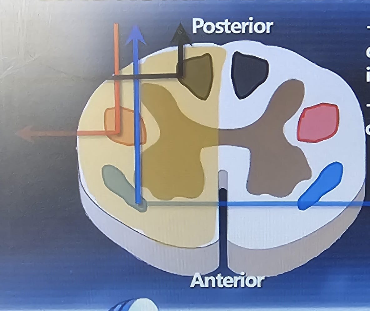 <p>corticoespinhal (motor): feixe de neurônios</p><ul><li><p>nasce de um lado, cruza no tronco e desce cruzado na medula = INCENTIVO MOTOR CONTRALATERAL</p></li></ul><p>espinotalâmico (dor e temperatura): entra na medula e já cruza pro outro lado = percebe sensações do outro lado</p><p>espinocerebelar (propriocepção, vibração): ipsilateral</p><p></p><p>sd medular anterior: disfunção motora e sensitiva; alteração esfincteriana; propriocepção e vibração preservadas</p><p>sd medular central: disfunção motora (geralmente mais intensa em mmss se cervical)</p><p>sd medular posterior: perde propriocepção e sensibilidade vibratória bilateral; motor e termoalgésica preservados</p><p>brown séquard: hemiplegia e perda propriocepção ipsilateral, <br>perda sensibilidade dolorosa/térmica contralateral</p>