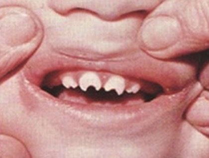 <p><span><span>This child's teeth erupted like this. What is the condition?</span></span></p>