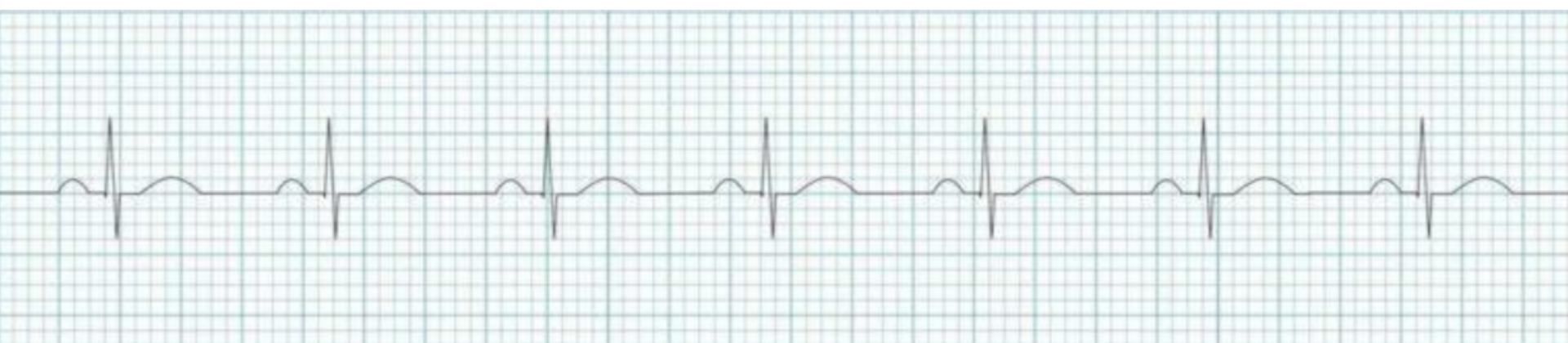<p>Rate: 60-100</p><p>rhythm: even, P-P even and R-R even</p><p>measurement: PR: 0.2 or less sec (less than or equal to 5 boxes), QRS: 0.12 sec or less (less than or equal to 3 boxes), QT varies</p>