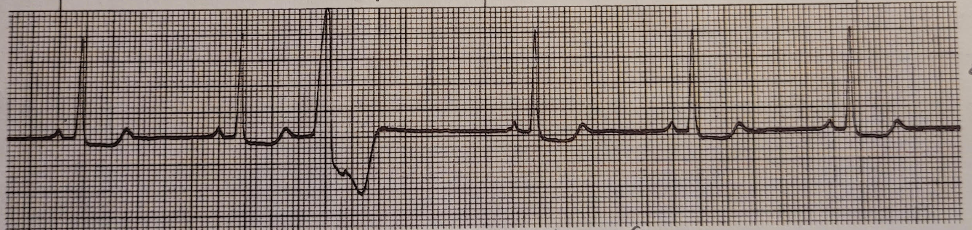 <p>how do yk this is a unifocal PVC</p>