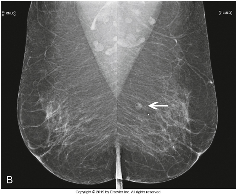 <p>triangular in shape and originates from the clavicle, sternum and ribs</p><p>inserts into the lateral border of the bicipital groove of the humerus and lies between the breast tissue and ribs</p><p><u>shows as white trainagular densitis </u></p>