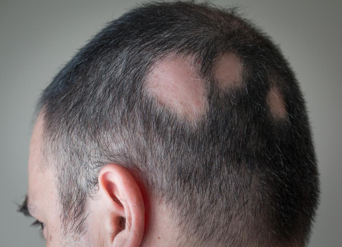 <p>Sudden, rapid, coin-shaped loss of hair, usually from the scalp or face.</p>