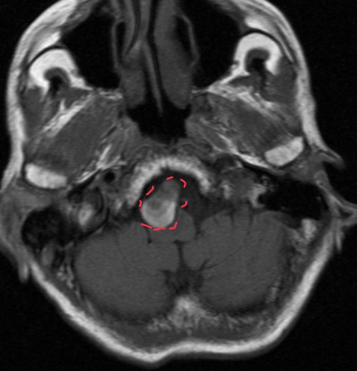 <p>55-year-old female presents with occipital headaches and neck stiffness</p>