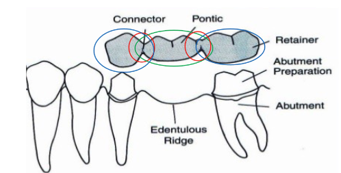 <ol><li><p>Retainer</p></li><li><p>Pontic</p></li><li><p>Connector</p></li></ol><p></p>