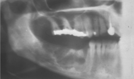 <p>Radiographic Borders : borders that are not well demarcated, making it difficult to detect exact parameters </p>