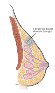 <p>Benign breast disease marked by round, elastic, defined, tender, and mobile cysts</p><p>Fibrocystic breasts are normal two weeks prior to period, then lumps decrease in size during period and a week after</p>