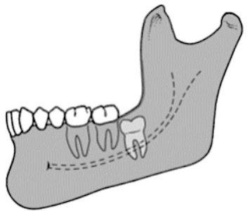 <p>impacted tooth is <span style="color: red;">below the cervical line </span>of the second molar</p>