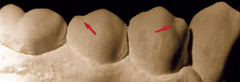 <p>Is the buccal developmental groove located mesial or distal on mandibular first premolars?</p>