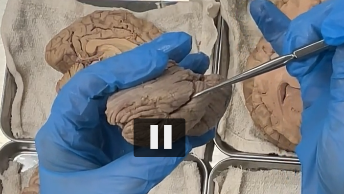 <p>lateral view of the <strong>horizontal fissure: </strong>splits the cerebellum into a superior and inferior or upper and lower part of the cerebellum. </p>