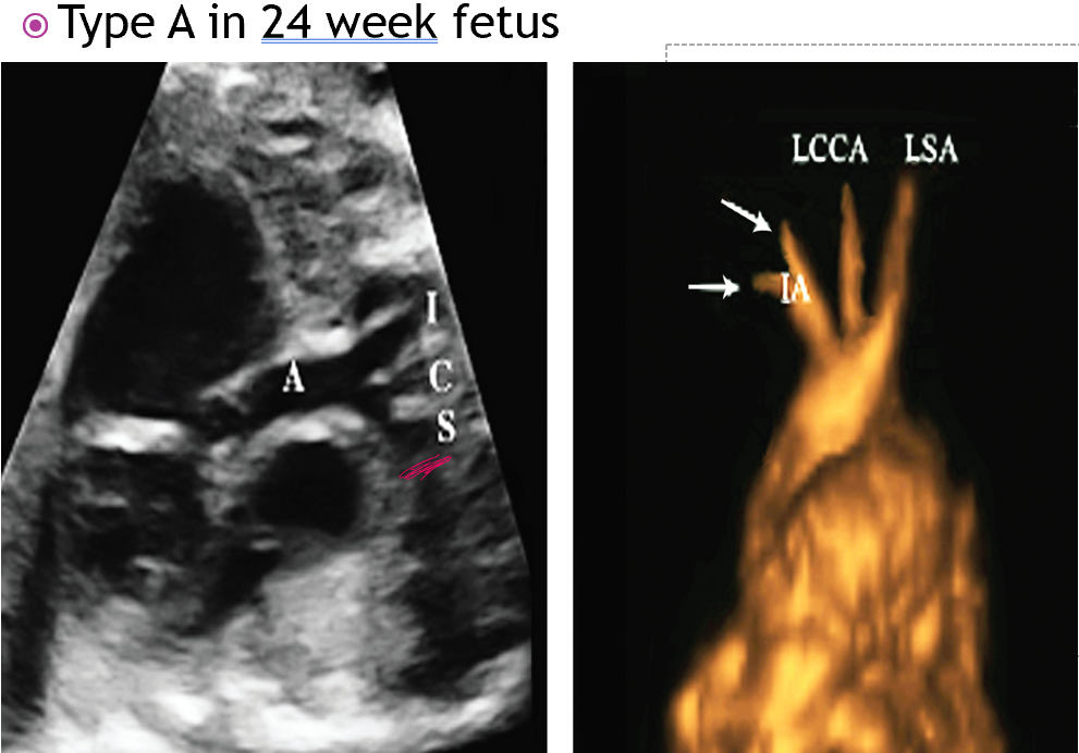 <p>difference of BP of upper and lower extremities </p>