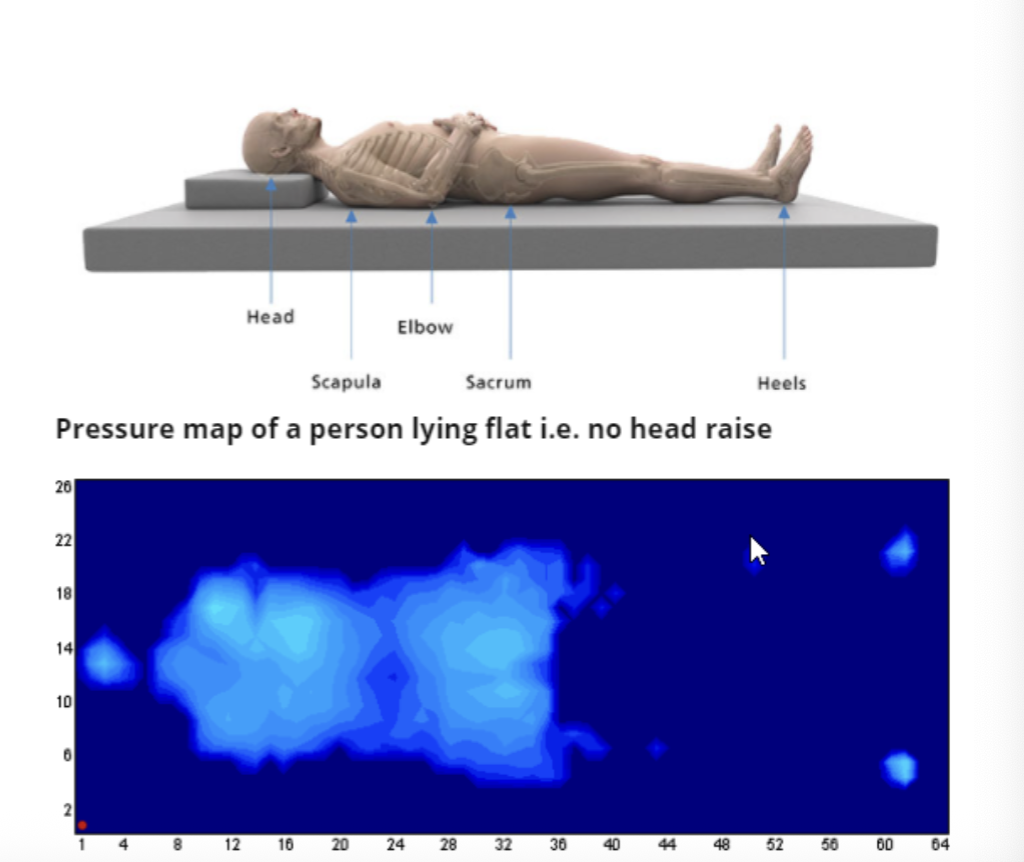 <ul><li><p>single pillow placed under head</p></li><li><p>pillow placed under affected shoulder and arm</p><ul><li><p>slight shoulder flexion, abduction, neutral rotation</p></li></ul></li><li><p>high tone- place pillows or blanket rolls to assist in positioning the arm away rom the body</p></li><li><p>LEs neutral- extension, slight hip ER, slight hib abd</p></li><li><p>use towel rolls to prop heel to reduce heel pressure</p></li><li><p>use pillows to elevate LE with edema</p></li></ul><p></p>